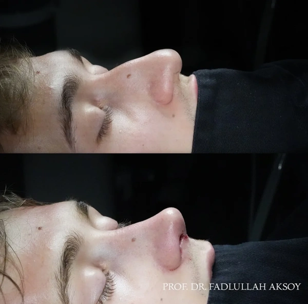 Rhinoplasty (Nose job) before and after gallery – Male case 486
