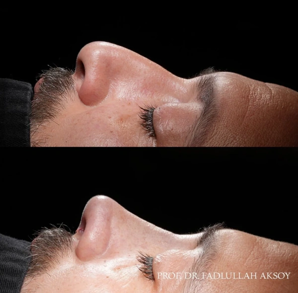 Fadlullah AKSOY Rhinoplasty (Nose job) results in Turkey – case 490