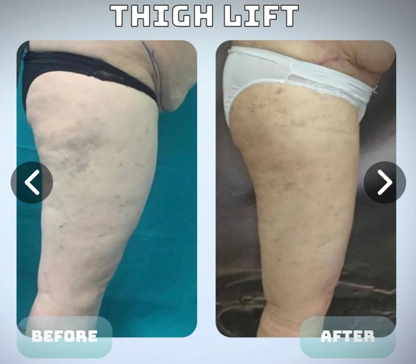 Duran Cekic Full Body Lift results in Turkey – case 89