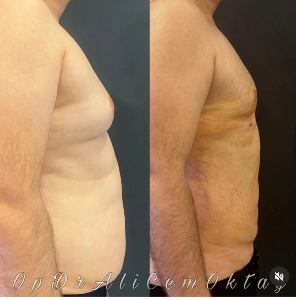 Ali Cem Oktay Tummy Tuck (Abdominoplasty) results in Turkey – case 76