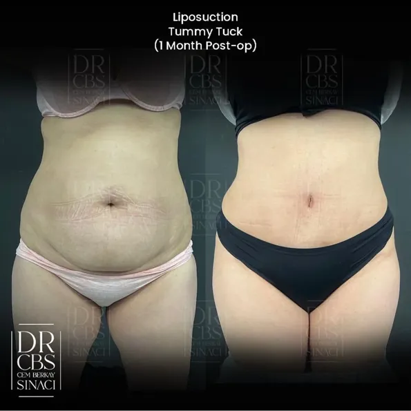 Tummy Tuck (Abdominoplasty) before and after results in Turkey – case 317