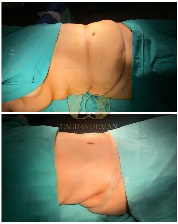 Tummy Tuck (Abdominoplasty) before and after results in Turkey – case 183