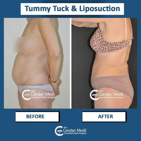 Tummy Tuck (Abdominoplasty) before and after results in Turkey – case 454