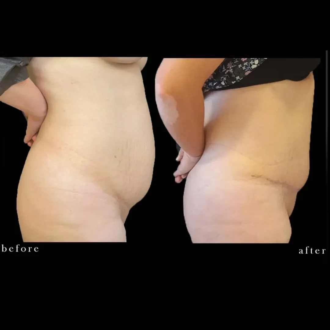 Qué celebridades se han sometido a una abdominoplastia? | Medelysium, image size:1080x1080