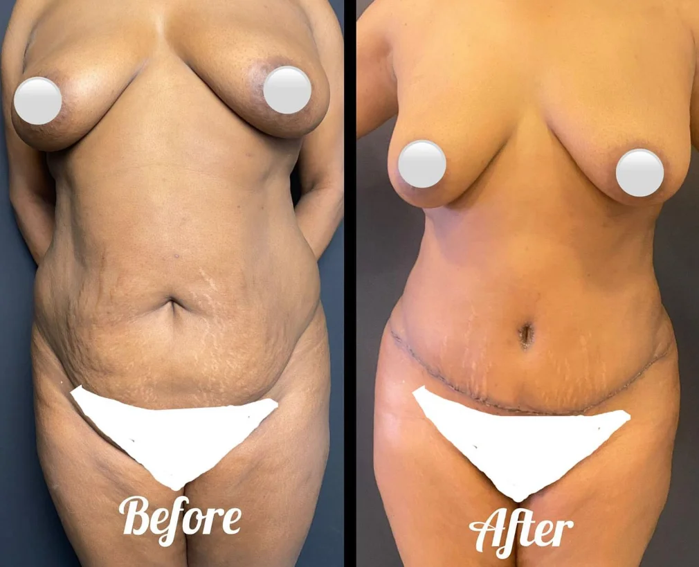 Qué celebridades se han sometido a una abdominoplastia? | Medelysium, image size:1010x819