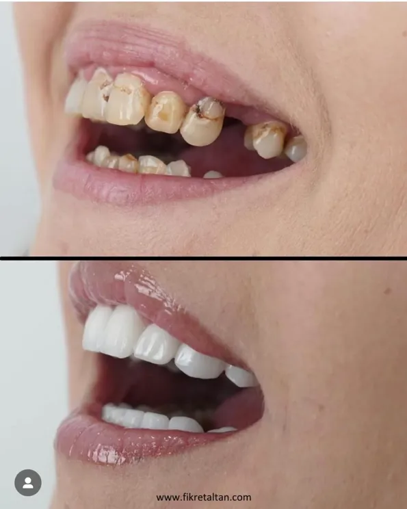 Resultados antes y después de Implantes Dentales en Turquía – caso 344