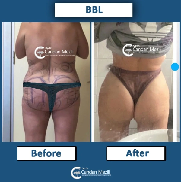 El proceso de BBL (Levantamiento De Glúteos Brasileño) con fotos del antes y después – caso 581