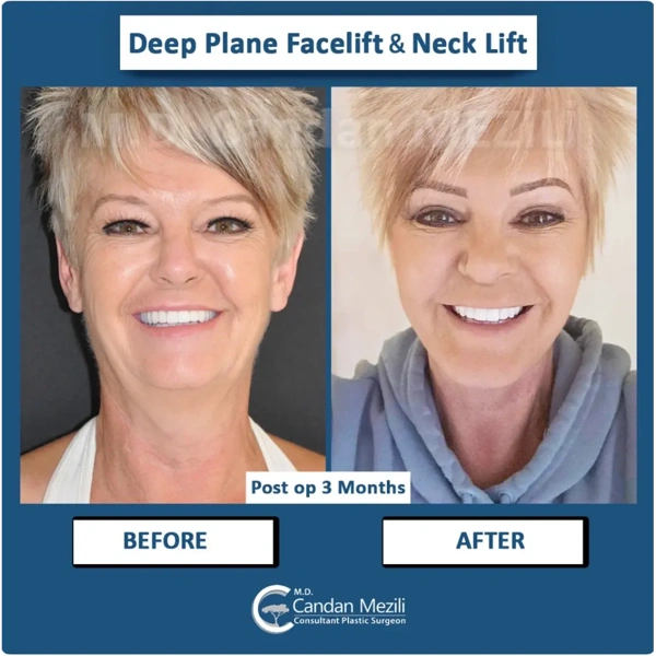 Resultados antes y después del paquete Lifting facial en el extranjero – caso 573
