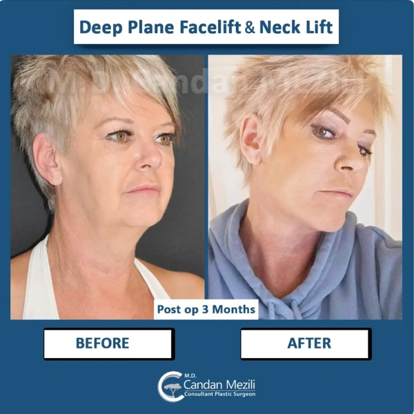 Resultados antes y después del paquete Lifting facial en el extranjero – caso 574