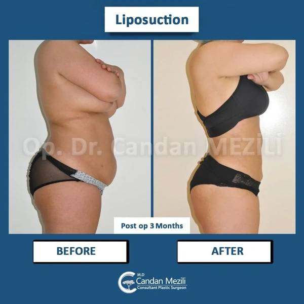 El proceso de Liposucción con fotos del antes y después – caso 460