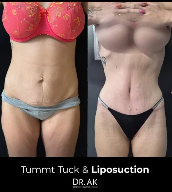 Resultados antes y después del paquete Liposucción en el extranjero – caso 612