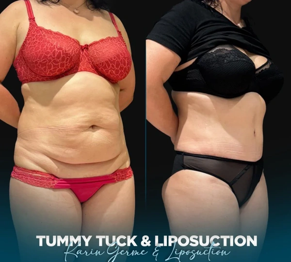 El proceso de Liposucción con fotos del antes y después – caso 655