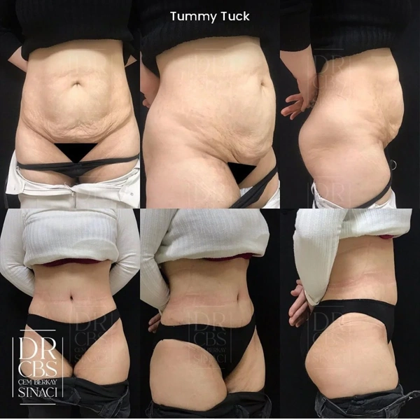 Cem Berkay  Sinaci Abdominoplastie results in Turkey – case 318