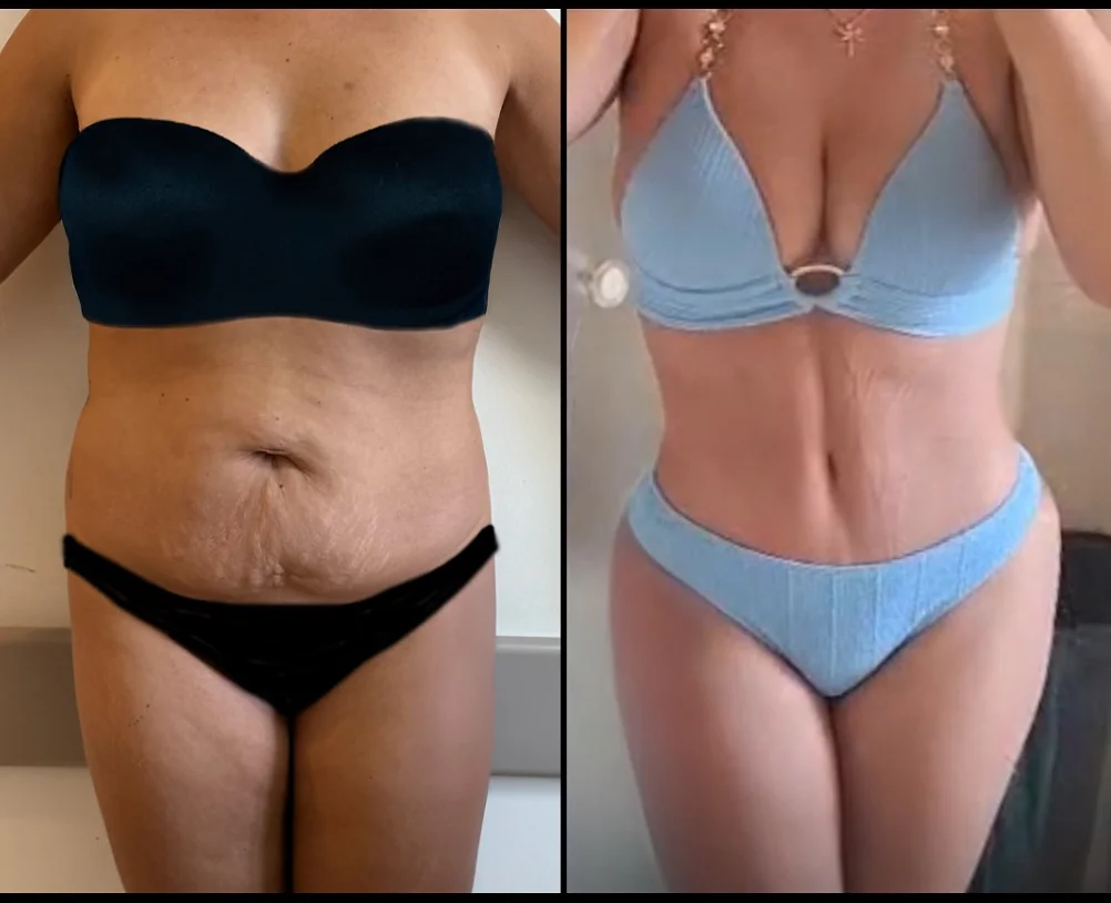 Quels célébrités ont subi une abdominoplastie ? | Medelysium, image size:1002x814
