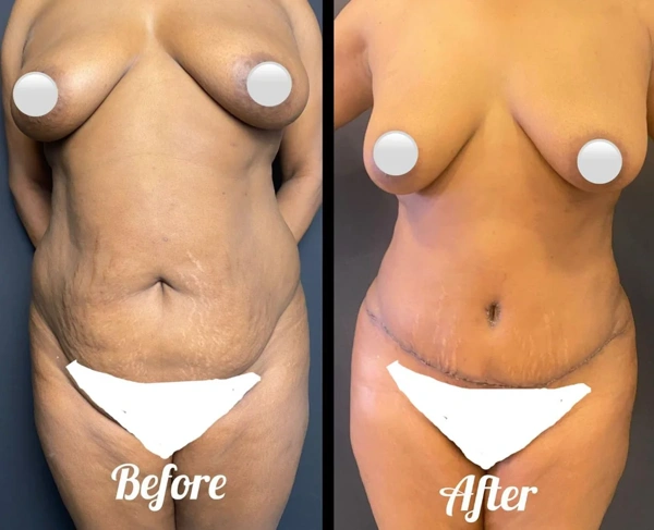 Duran Cekic Abdominoplastie results in Turkey – case 640