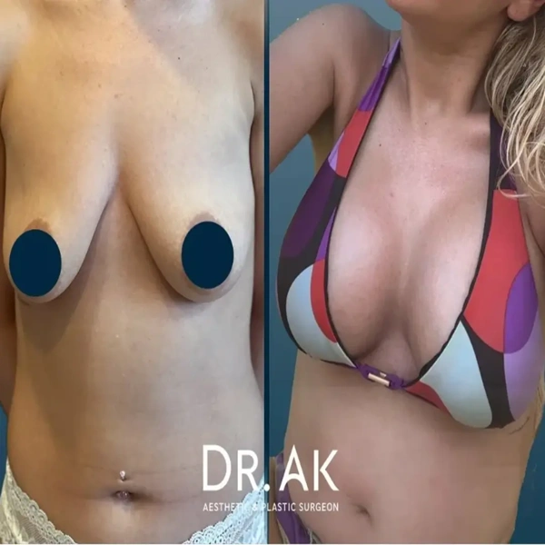 Erman Ak Augmentation mammaire results in Turkey – case 600