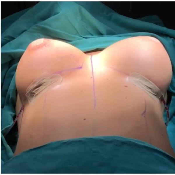 Cagdas Orman Augmentation mammaire results in Turkey – case 673