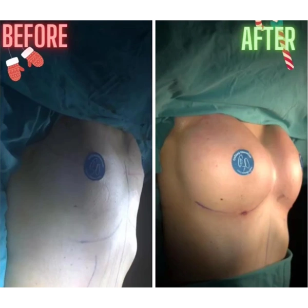 Cagdas Orman Augmentation mammaire results in Turkey – case 675