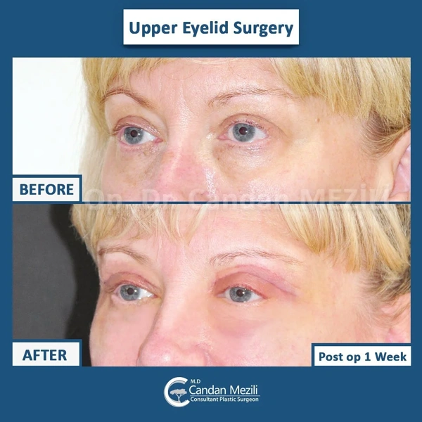 Candan Mezili Blépharoplastie (chirurgie des paupières) results in Turkey – case 463