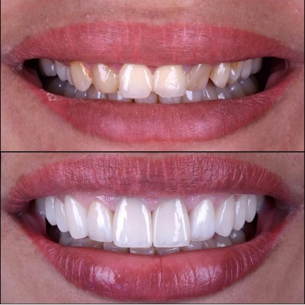 Ozgur  Bultan Facettes dentaires results in Turkey – case 335