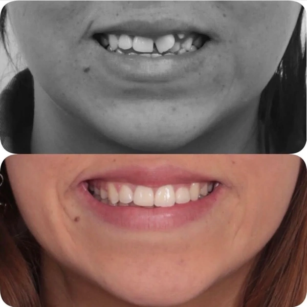 Merve  Ozkan Akagunduz Facettes dentaires results in Turkey – case 418