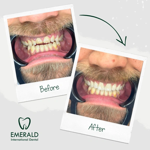 Cemal Onder Facettes dentaires results in Turkey – case 424