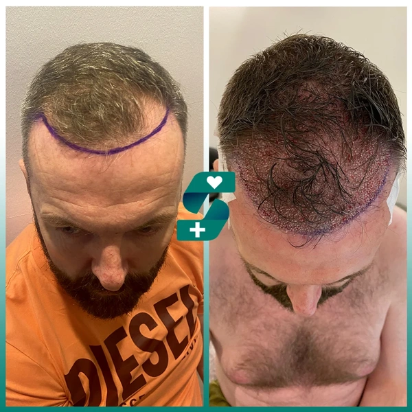 Ilayda  Yuceturk Greffe De Cheveux results in Turkey – case 512