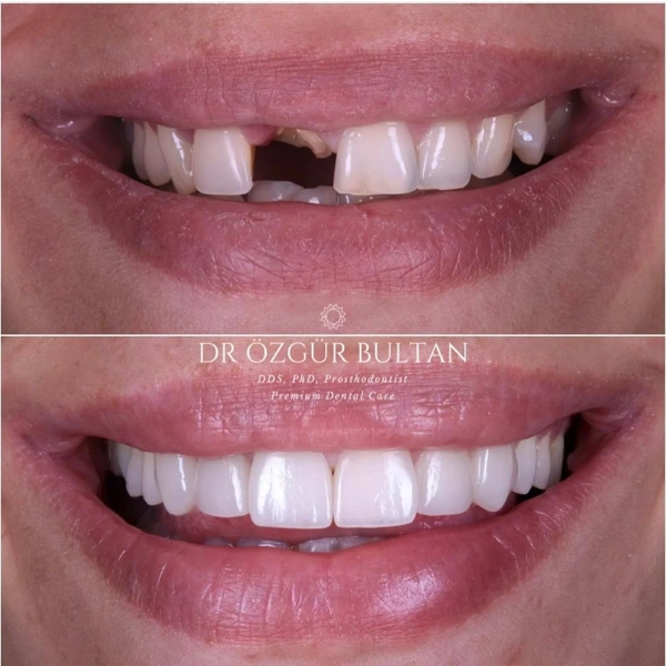 Ozgur  Bultan Implants Dentaires results in Turkey – case 328