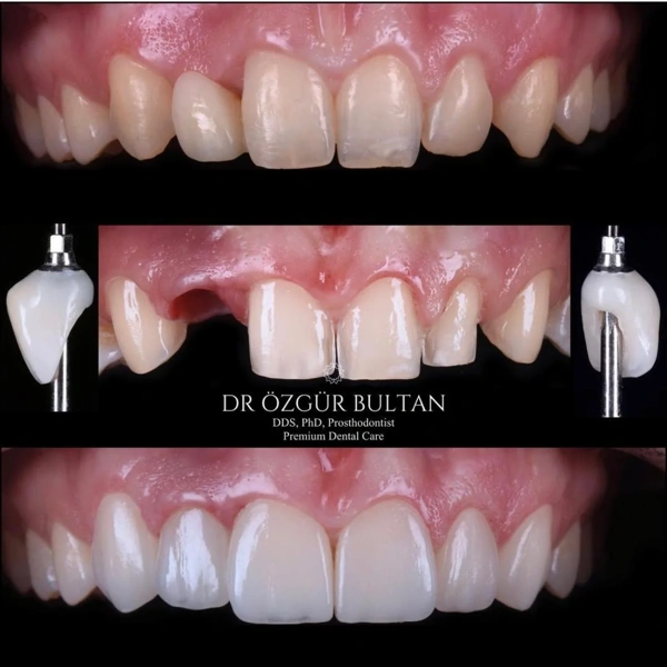 Ozgur  Bultan Implants Dentaires results in Turkey – case 329