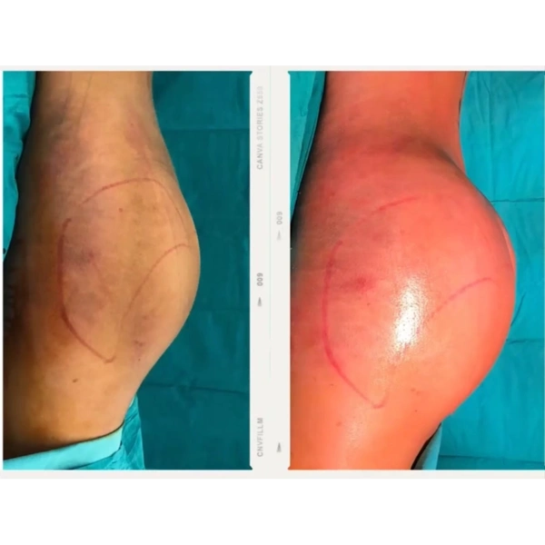 Cagdas Orman BBL (Lifting brésilien des fesses) results in Turkey – case 668