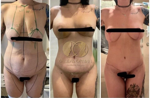 Cagdas Orman Lifting des seins results in Turkey – case 167