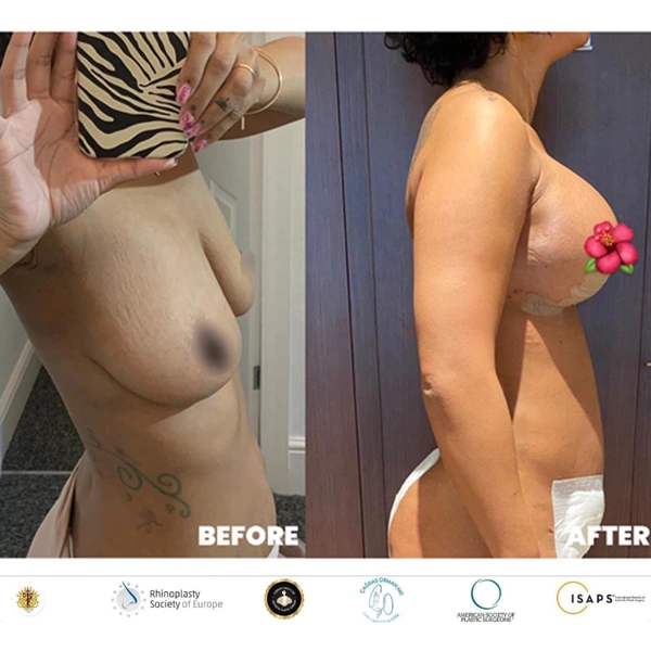 Cagdas Orman Lifting des seins results in Turkey – case 679