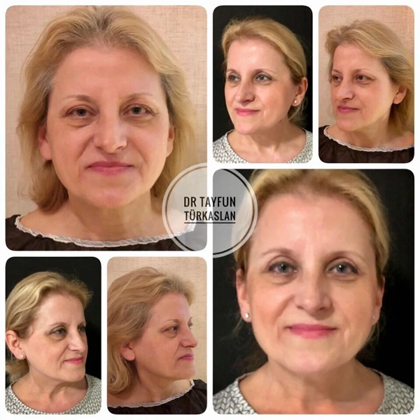 Tayfun Turkaslan Lifting du visage results in Turkey – case 48