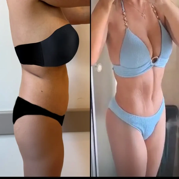 Galerie avant–après Liposuccion – Femme cas 613