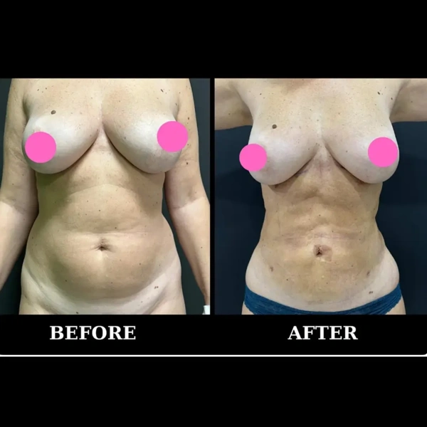 Duran Cekic Liposuccion results in Turkey – case 636