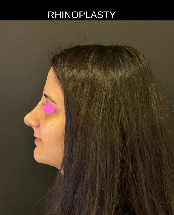 Duran Cekic Rhinoplastie (Opération du nez) results in Turkey – case 96