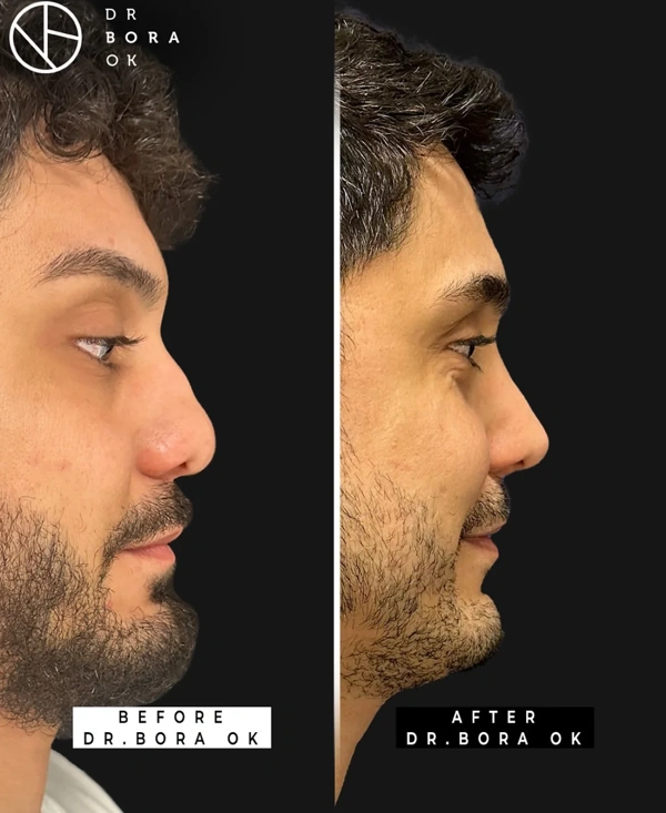 Bora  Ok Rhinoplastie (Opération du nez) results in Turkey – case 156