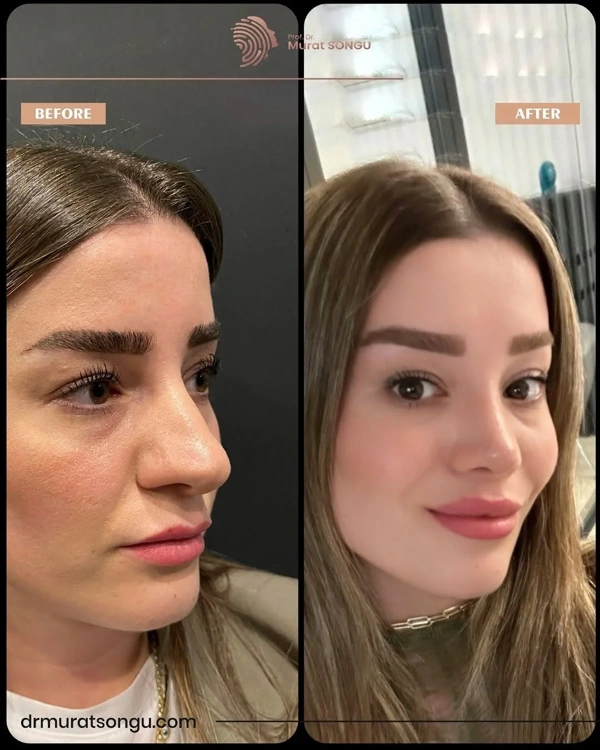 Murat Songu Rhinoplastie (Opération du nez) results in Turkey – case 21