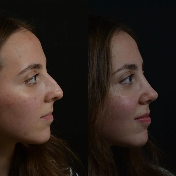 Alev Camcioglu Rhinoplastie (Opération du nez) results in Turkey – case 23