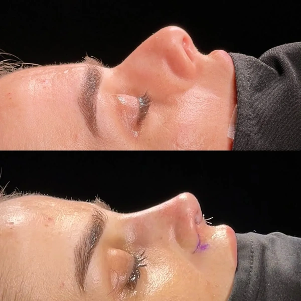 Yunus Kaplan Rhinoplastie (Opération du nez) results in Turkey – case 30