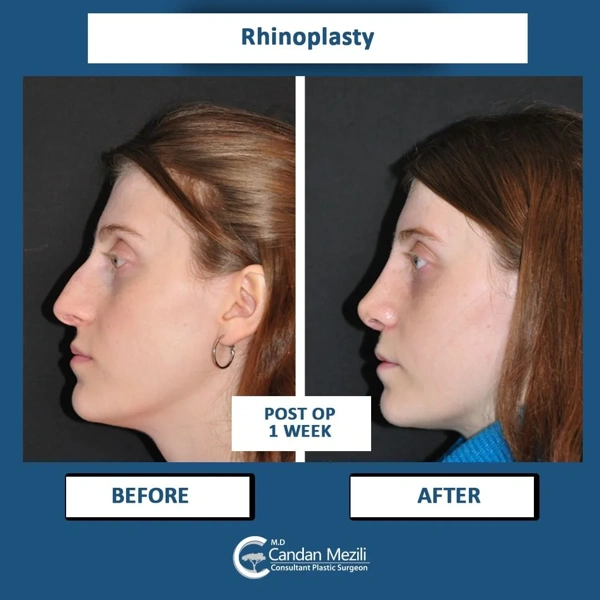 Candan Mezili Rhinoplastie (Opération du nez) results in Turkey – case 442