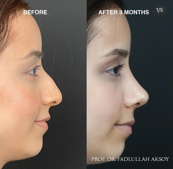 Fadlullah AKSOY Rhinoplastie (Opération du nez) results in Turkey – case 491