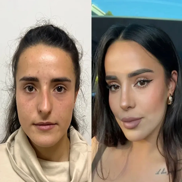 Erman Ak Rhinoplastie (Opération du nez) results in Turkey – case 618