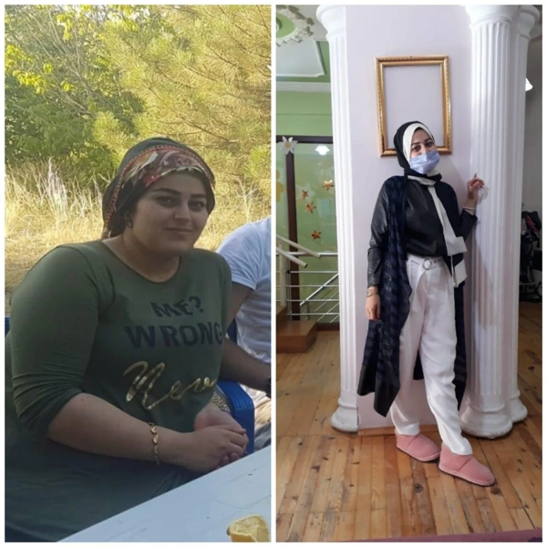 Ibrahim Karatas Sleeve Gastrique results in Turkey – case 306
