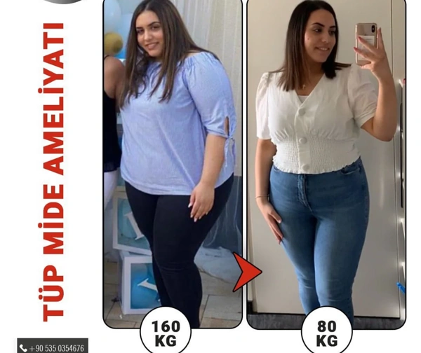 Levent Bakısgan Sleeve Gastrique results in Turkey – case 501