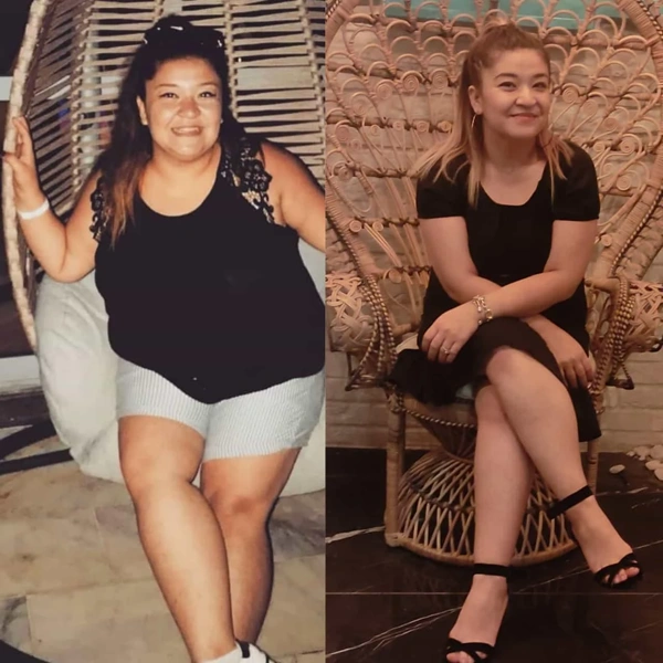 Ibrahim Karatas Gastrectomia a manica results in Turkey – case 304
