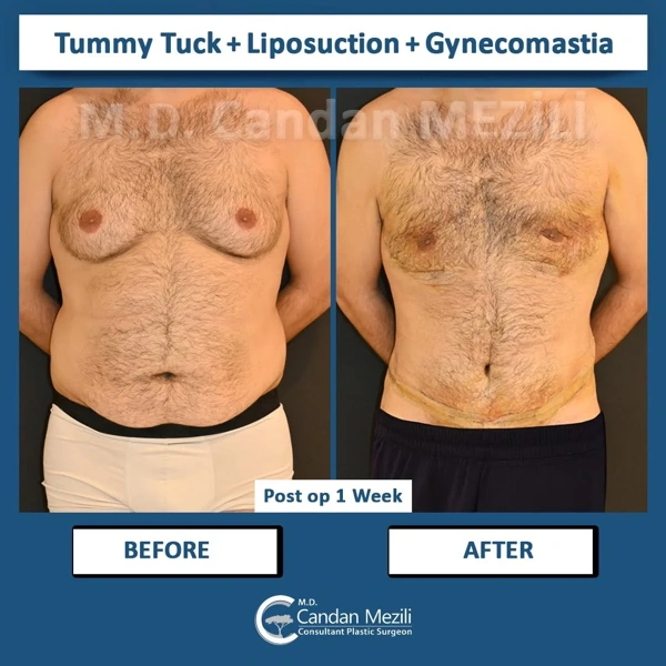 Candan Mezili Chirurgia della ginecomastia results in Turkey – case 11