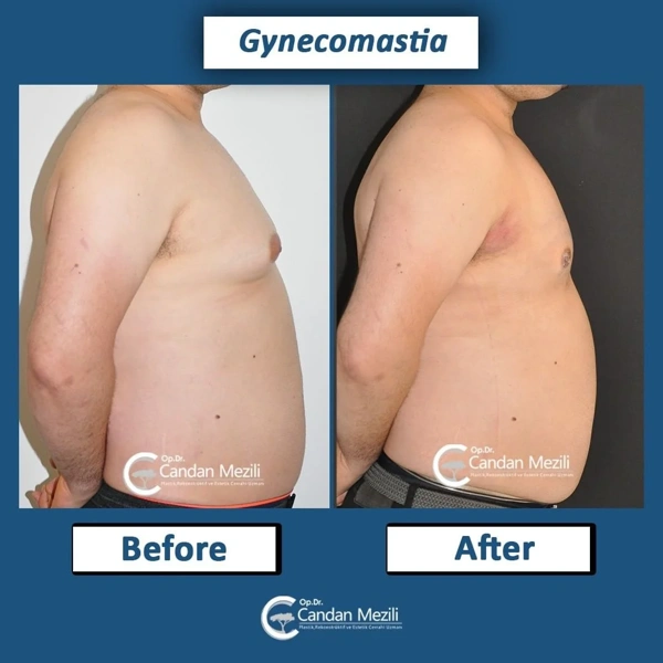 Galleria prima e dopo Chirurgia della ginecomastia – Maschio caso 446
