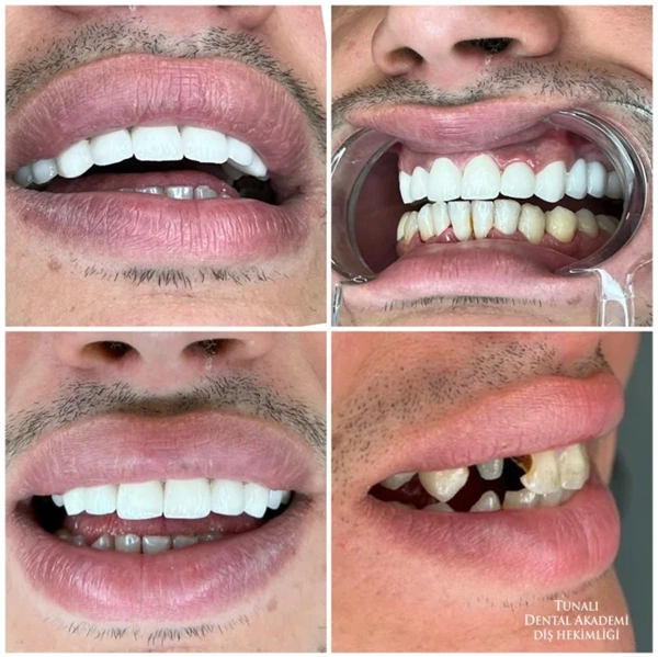 Il percorso di Impianto dentali con foto prima–dopo – caso 260