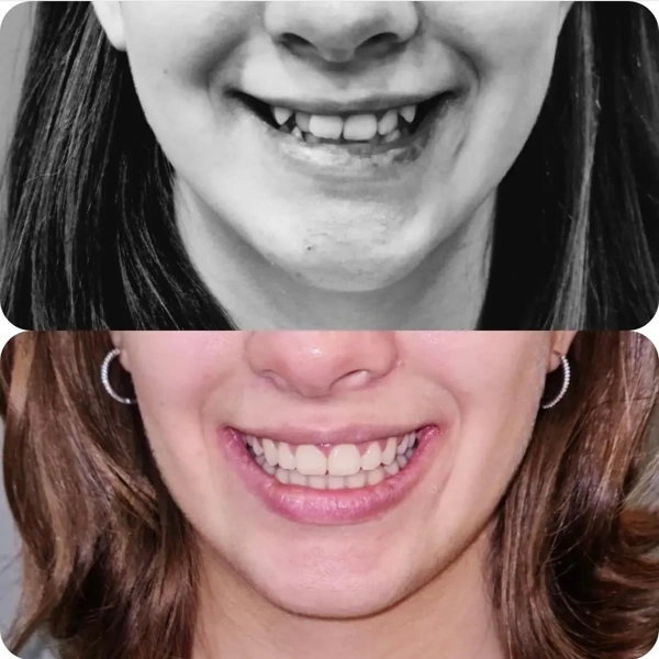 Merve  Ozkan Akagunduz Faccette dentali results in Turkey – case 420